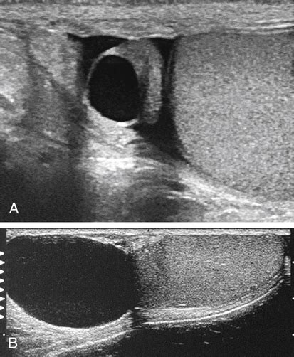 Scrotal Mass and Scrotal Pain | Radiology Key