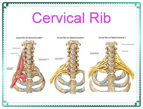 Cervical Rib | Cervical, Rib, Medical history