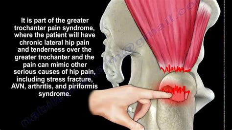 Gluteus Medius Mri Anatomy - ANATOMY STRUCTURE