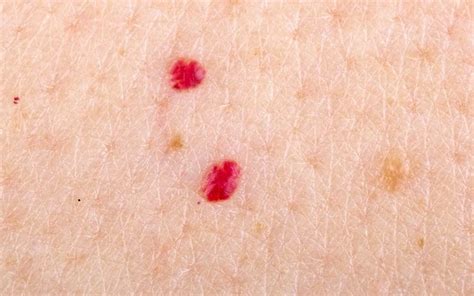 Cherry Angioma: How to Remove Cherry Angiomas (Red "Moles")