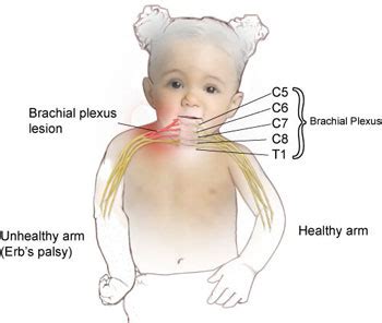 Erb's palsy - Cause, Symptoms, Treatment, Exercise | Samarpan Physio.