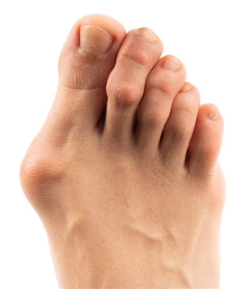 Bunions: Causes, Types, and Treatments | Canyon Oaks Foot & Ankle