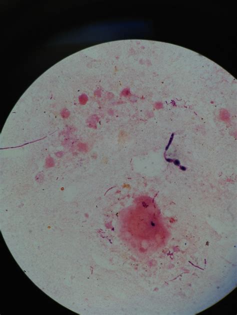 microaerophilic: following up on the pleural... | Laboratory Science Review