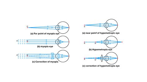 Which lens is used for presbyopia? Give reasons.