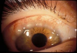 EyeRounds.org: Vernal Keratoconjunctivitis: 8 year-old asthmatic male with reduced vision