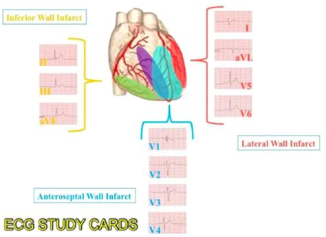 ECG lead correlation w/ coronary arteries Flashcards | Quizlet