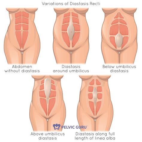 Do you have diastasis recti? You may also have pelvic floor dysfunction - Well-Being Pelvic ...