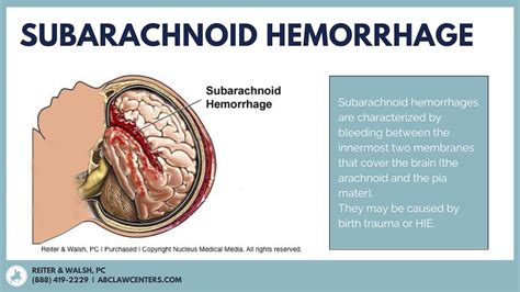 Subarachnoid Hemorrhage in Newborns | Subarachnoid hemorrhage, Intracranial hemorrhage, Hemorrhage