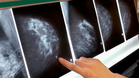 Breast cancer therapies can raise heart risks, doctors warn - CNN