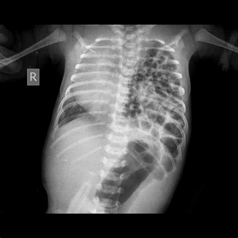 Diaphragmatic Hernia X Ray