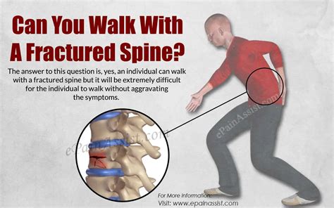 Compression Lumbar Fracture: Causes Treatment And Recovery – Brandon Orthopedics