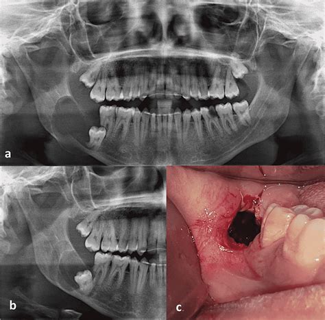 Marsupialization of Dentigerous Cysts Followed by Enucleation and Extraction of Deeply Impacted ...