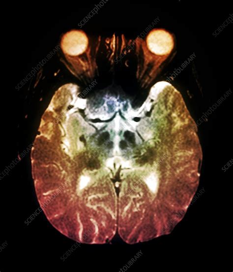 Parkinson's disease brain, MRI scan - Stock Image - C004/1464 - Science Photo Library