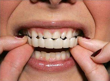 snap on teeth 2 - Dentalopolis