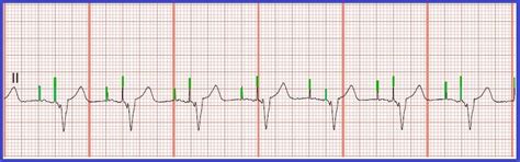 EKG Rhythm Strip Quiz 138