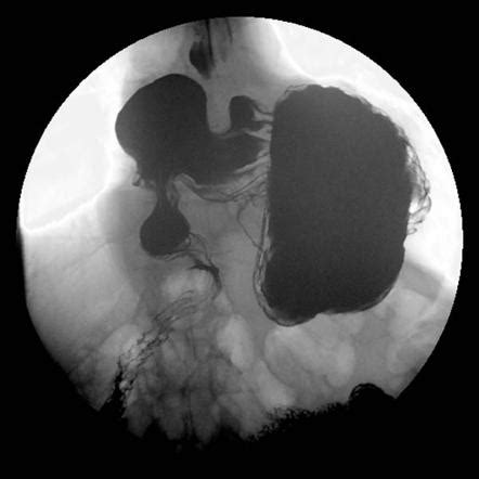 Gastric volvulus - organoaxial | Radiology Case | Radiopaedia.org