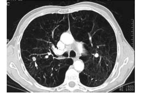 Upper Lobe Lung Nodule