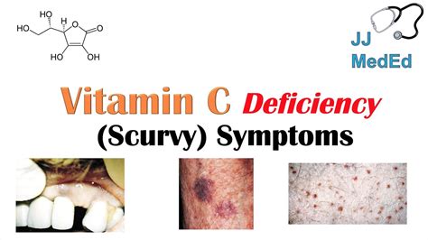 Vitamin C Deficiency (Scurvy) Symptoms (ex. bad teeth, fatigue), Why symptoms happen & who gets ...