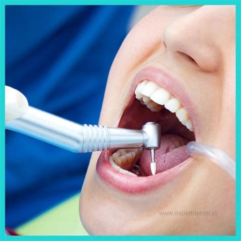 Teeth Cleaning - Expert Dental Care