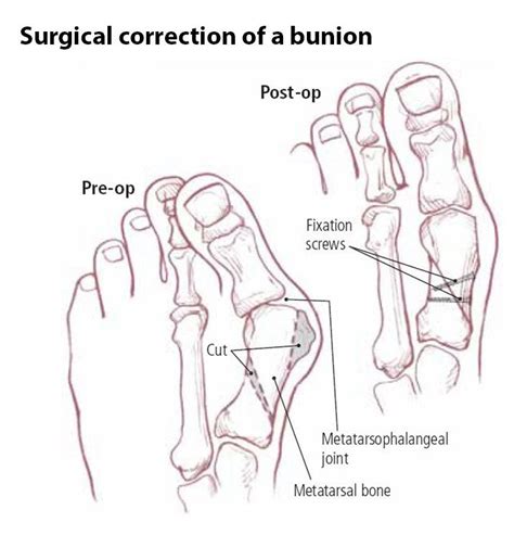 Bunion Guide: Causes, Symptoms and Treatment Options