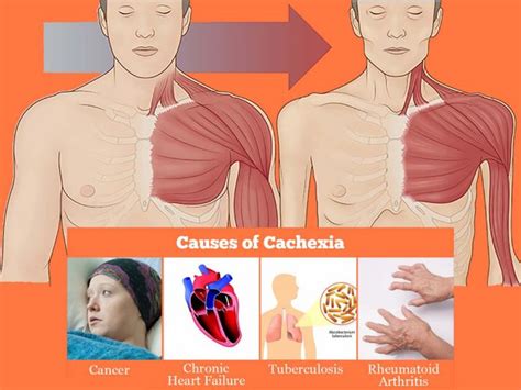 Researchers have described the molecular mechanisms of cachexia during ...