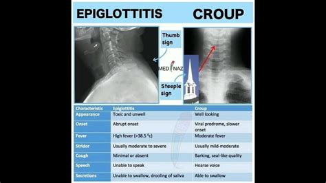 Epiglottitis Thumb Sign