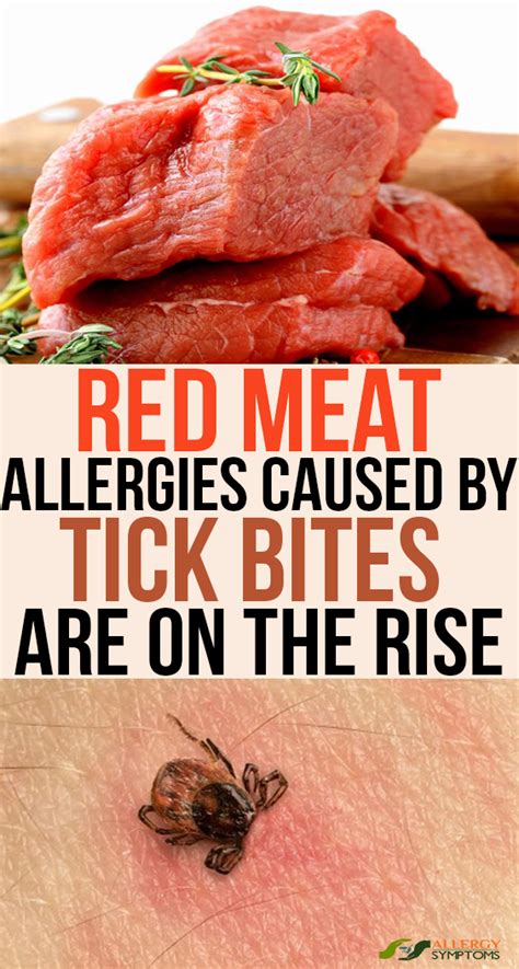 Red Meat Allergies Caused By Tick Bites Are On The Rise - Allergy Symptoms