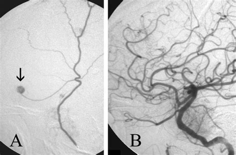 Right MMA aneurysm embolization. Lateral (A) view of the right MMA... | Download Scientific Diagram