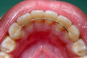 What is the difference between fixed retainer and removable retainer? | News | Dentagama