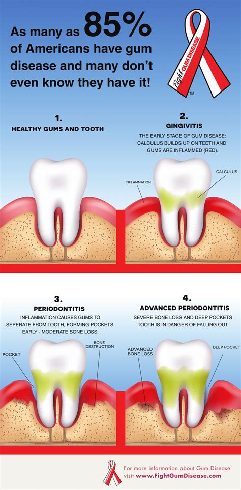 Diabetes & Gum Disease – Diabetes Daily