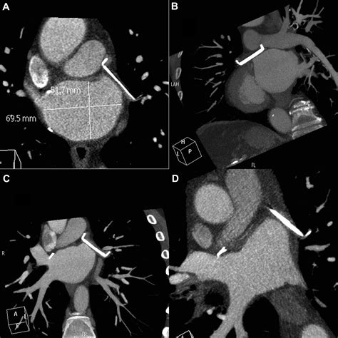 Angiographic Efficacy of the Atriclip Left Atrial Appendage Exclusion Device Placed by Minimally ...