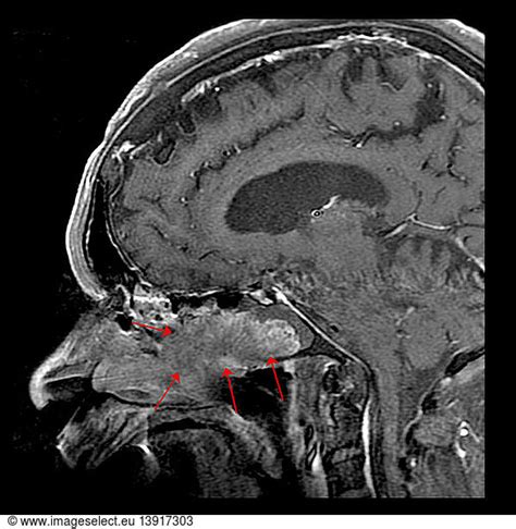 Inverted Papilloma Inverted Papilloma, MRI,abnormal,abnormality,cancer ...