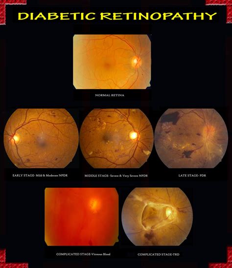 EYE PROBLEMS: DIABETIC RETINOPATHY