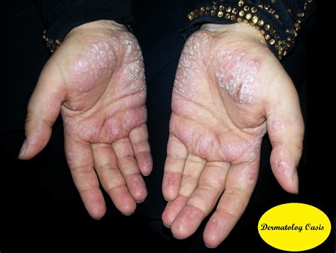 Psoriasis and Related Disorders | Dermatology Oasis