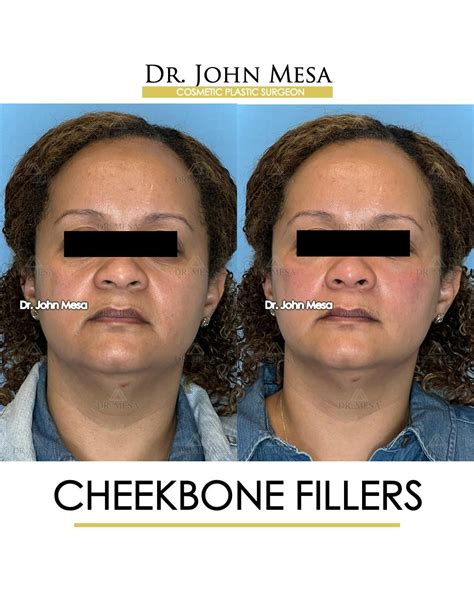 Cheekbone Filler Before & After Photos | Dr. Mesa