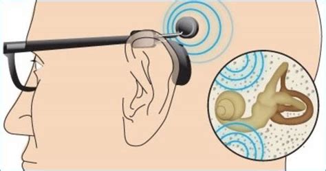 All Types of Hearing Aids - Features explained in detail