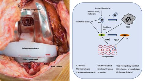 Arthrofibrosis: a multifaceted immunological problem