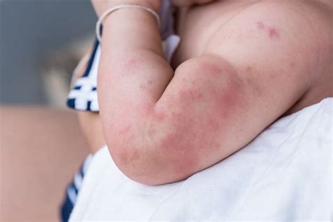 17 Most Common Types of Baby Rashes: With Pictures