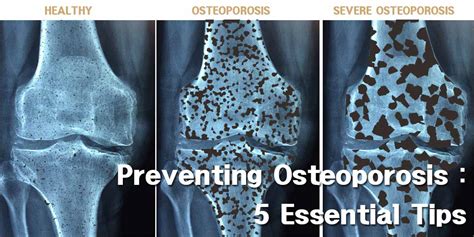 Preventing Osteoporosis : 5 Essential Tips - GetFitHive