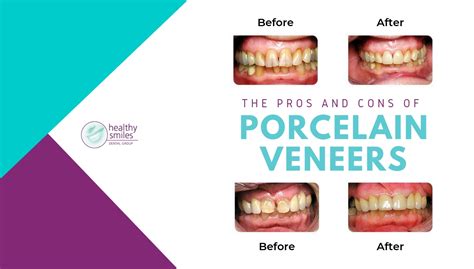 Pros and Cons of Porcelain Veneers: Are They Permanent? Healthy Smiles