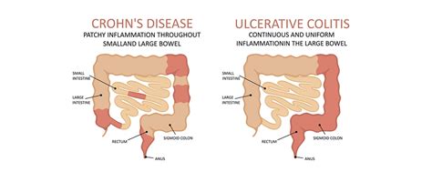 Crohn's and Colitis: What Exactly is the Distinction?