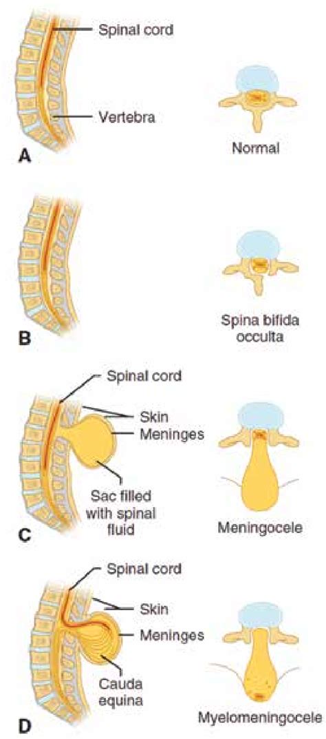 Types of Spina Bifida. (A) Normal anatomical structures. (B) Spina ...