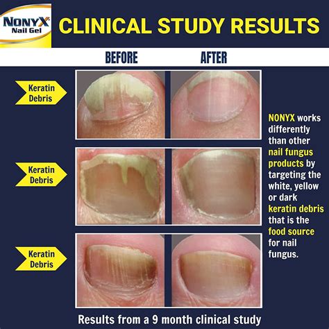 NONYX Nail Gel - Toenail Fungus Treatment for Clearing Fungus ...