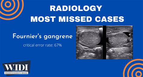 Most Missed Case: Fournier’s Gangrene » Wisdom in Diagnostic Imaging » College of Medicine ...