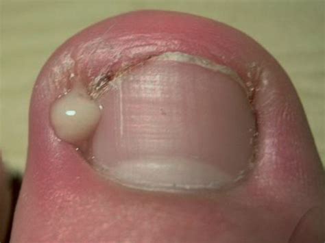 Ingrown Toenails — Mackay Ingrown Toenail Clinic