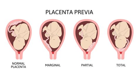 Placenta Previa - KWMA