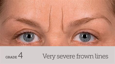 Frown Lines - Dark Eye Circles by Dr Gerard Ee Singapore