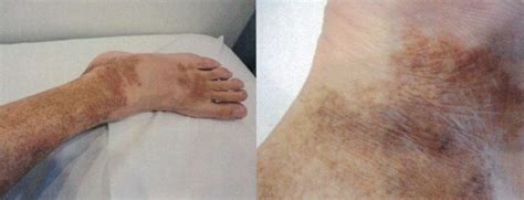 ACD A-Z of Skin - Pigmented Purpuric Dermatosis