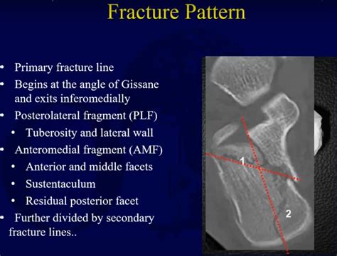 Calcaneal fractures – Anatomy, Evaluation and Classification — OrthopaedicPrinciples.com