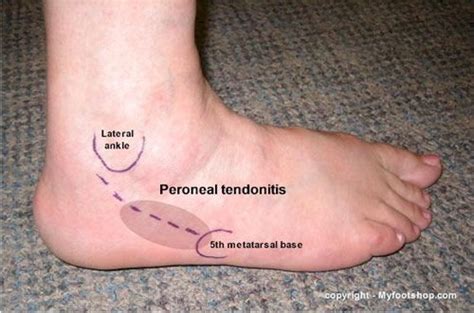 Peroneal Tendonitis | Causes and treatment options (Printer-friendly ...